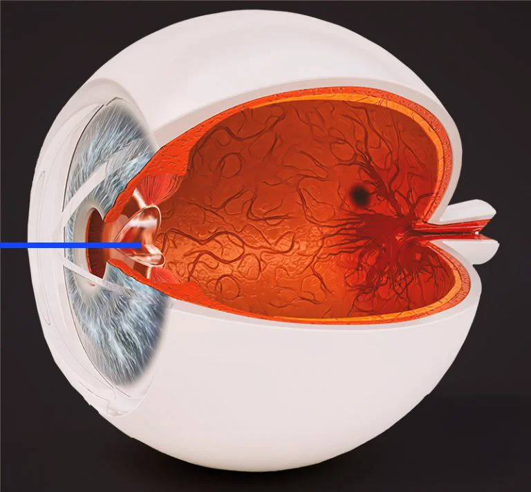 Eye surgery